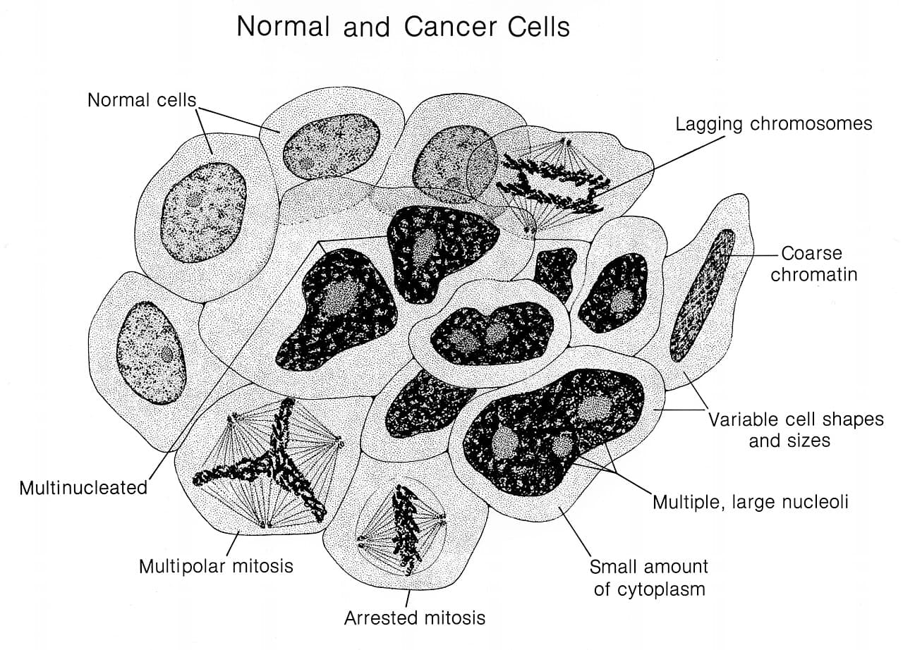Labeled medical illustration comparing a healthy cell with orderly rounded nuclei to a cancer cell with a large irregular nucleus dividing uncontrollably